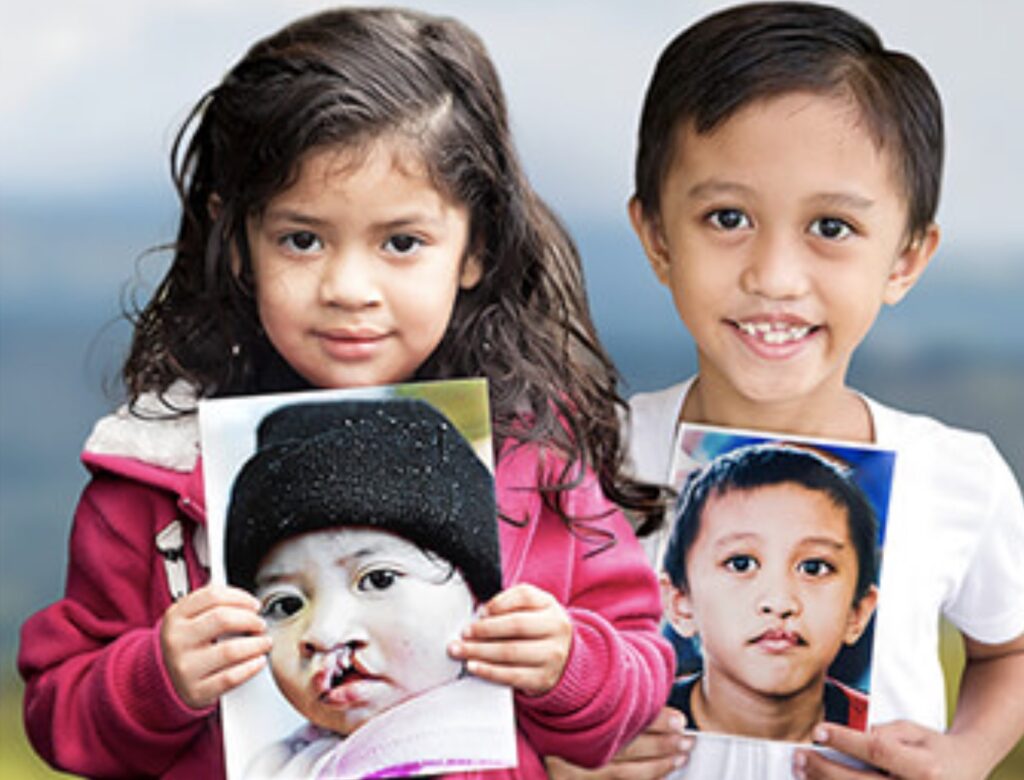 #3PorUnCambio: la iniciativa solidaria de Johnson & Johnson y Operation Smile México